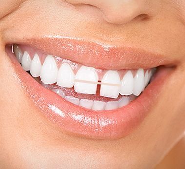 Gap Closing Dental Treatment – Sanidhya Dental
